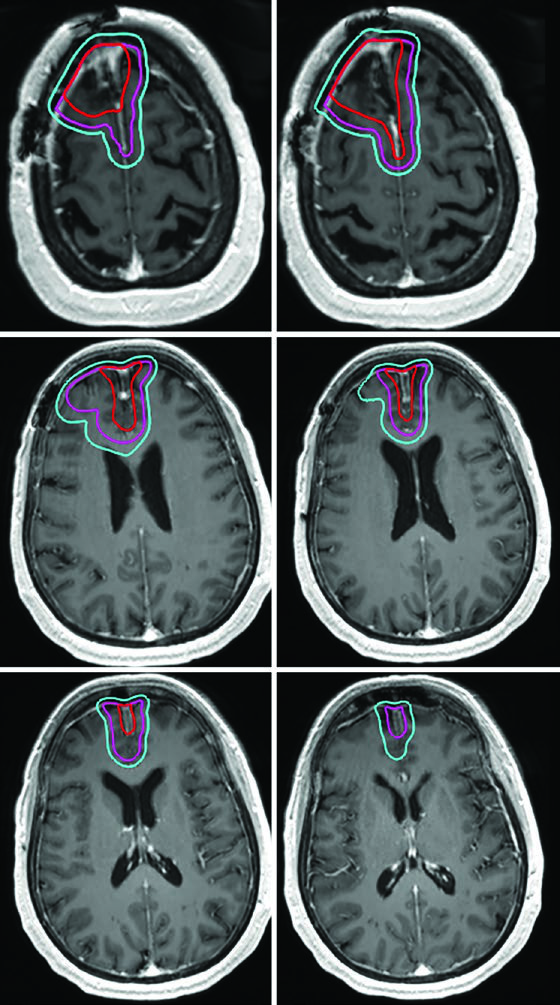 Post-contrast T1 MRI of an atypical parafalcine meningioma showing the surgical bed, original dural attachment, residual nodularity, a 0.5 cm CTV, and a 0.3 cm PTV.