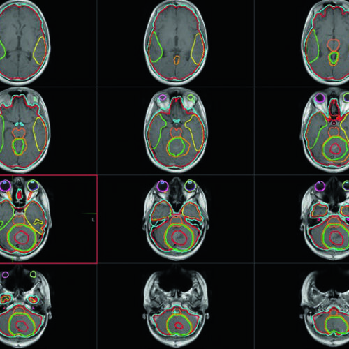 Tumores Cerebrais Pediátricos: Delineamento RT