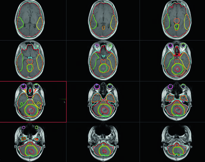 Tumores Cerebrales Pediátricos: Delineación RT