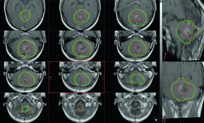 RM fusionada con TC de planificación mostrando GTV de la cavidad de resección, CTV y PTV del boost del lecho tumoral en meduloblastoma posoperatorio