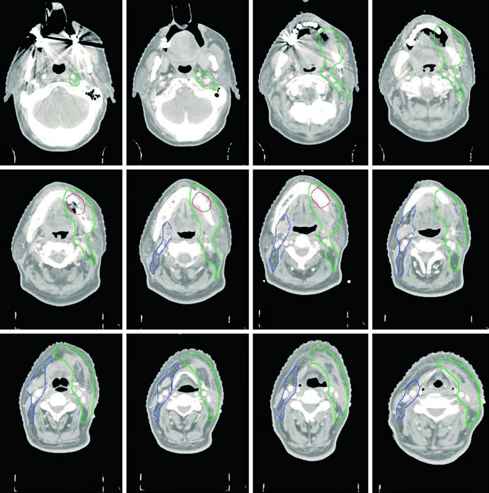 TC axial de planejamento em carcinoma de gengiva mostrando CTVs de alto, intermediario e baixo risco.