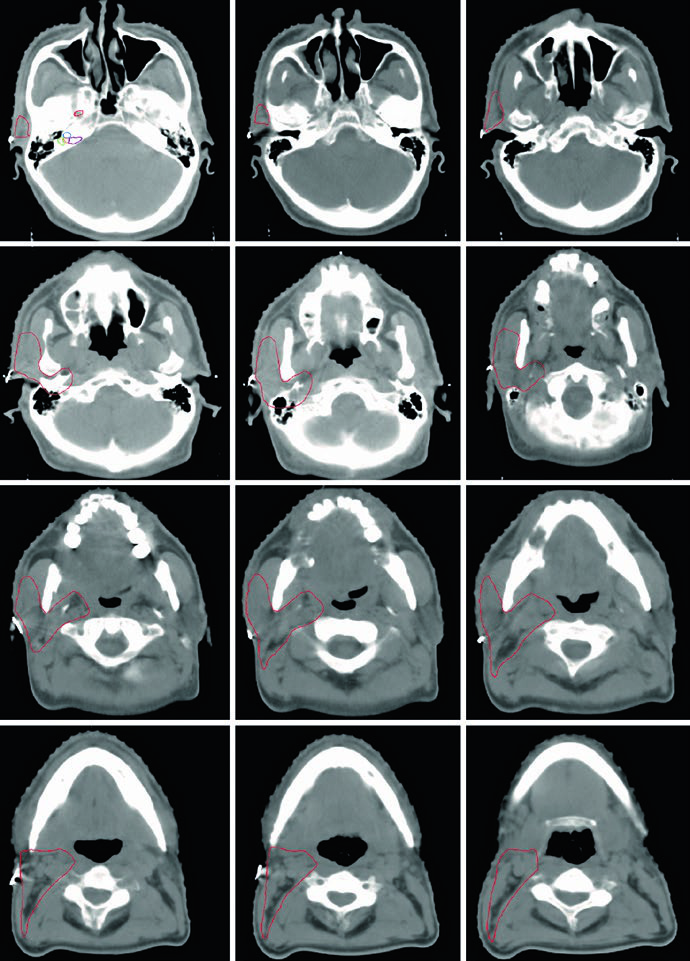 Glândulas Salivares: Delineamento e Planejamento