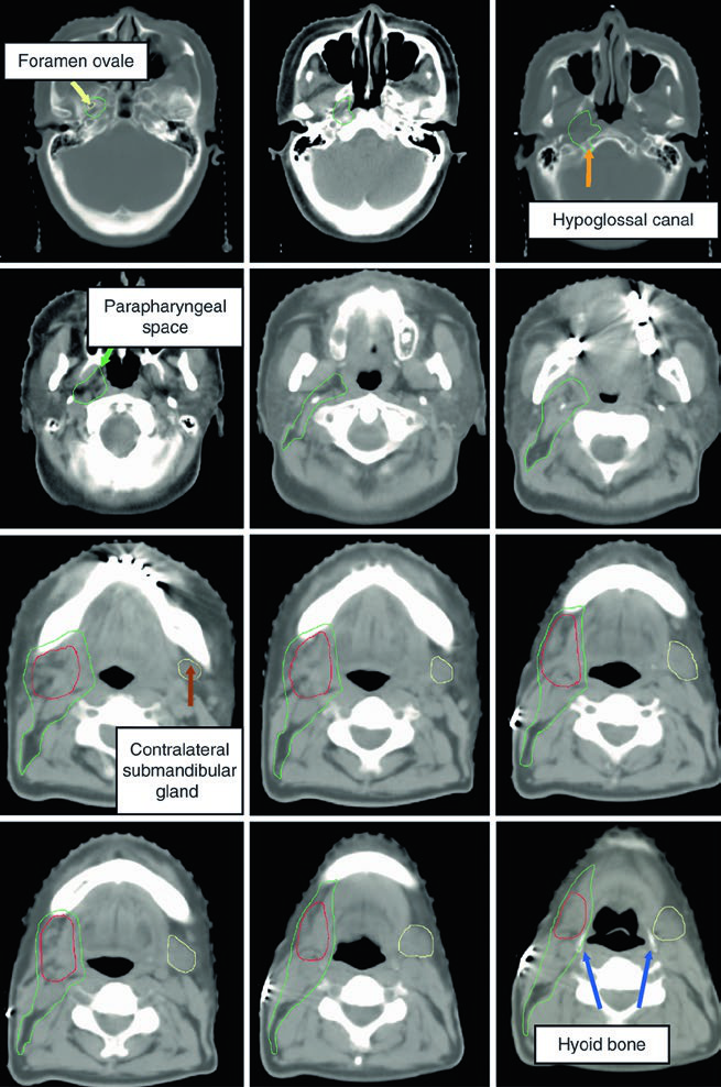 Tomografia de simulacao de glandula submandibular apos exérese completa com CTV do leito cirurgico e CTV nodal ipsilateral ate a base do cranio