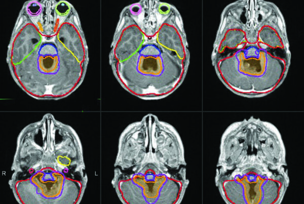 Axial fused MRI and planning images of pediatric infratentorial ependymoma showing boost volumes and organs at risk