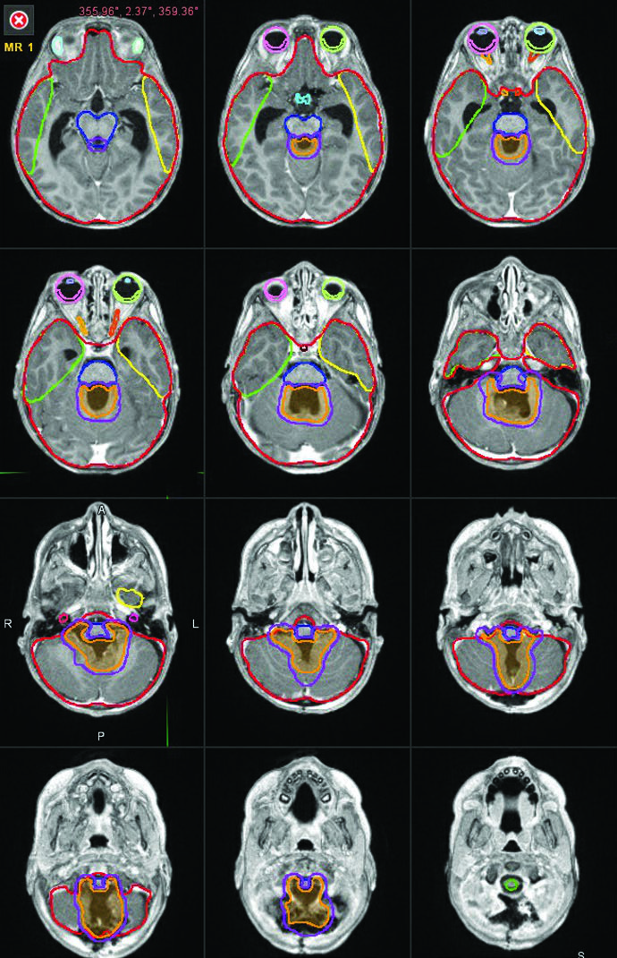 Tumores Cerebrais Pediátricos: Delineamento