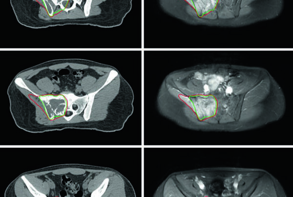Axial planning CT and pre-treatment MRI of pelvic Ewing sarcoma with GTV1 in red and GTV2 in green after induction chemotherapy