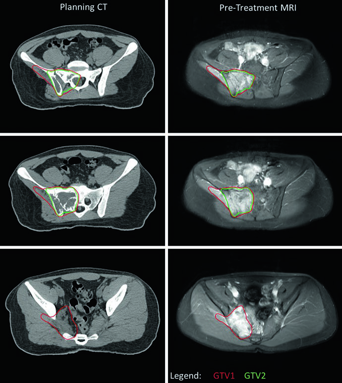 Sarcoma Pediátrico: Delineamento e Setup RT
