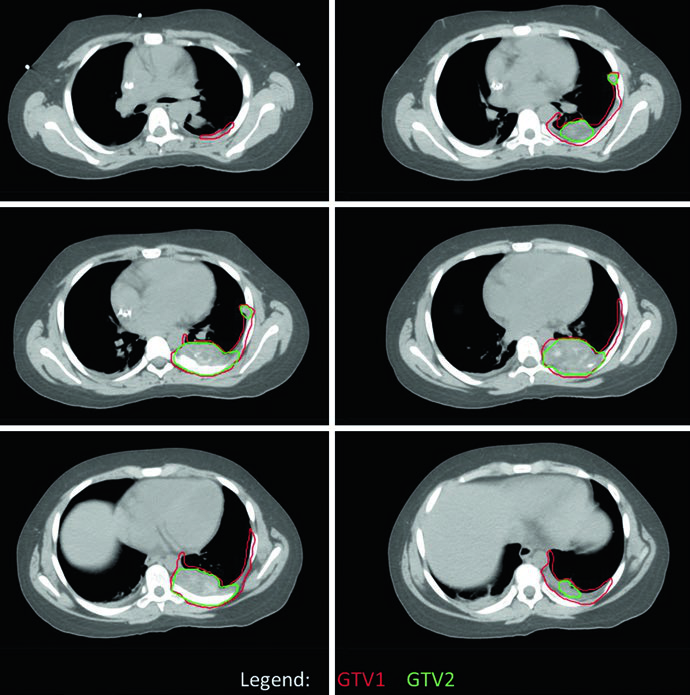 Cortes axiais de CT de simulacao de sarcoma de Ewing da parede toracica posterior esquerda com GTV1 em vermelho e GTV2 em verde