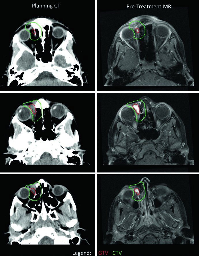 CT de planejamento e MRI pre-tratamento de rabdomiossarcoma orbitario com GTV em vermelho e CTV em verde
