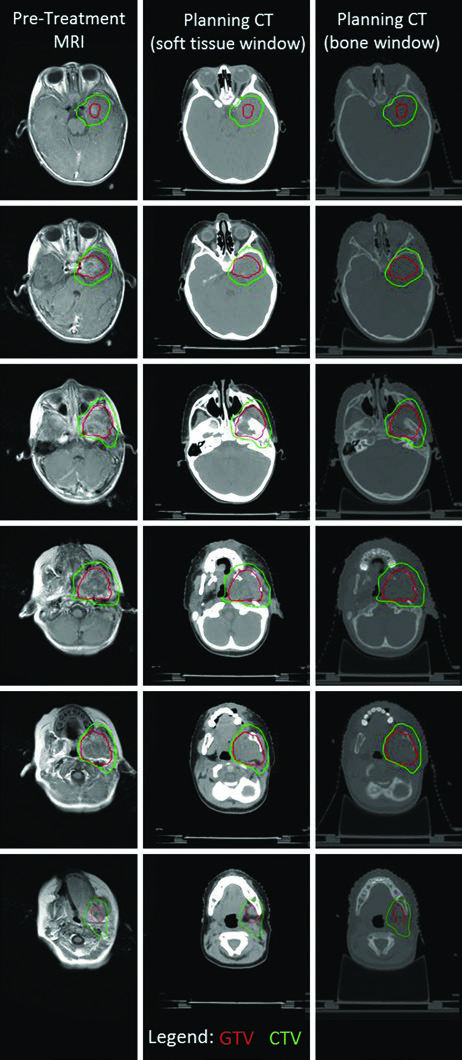 MRI pre-tratamento e CT de planejamento de rabdomiossarcoma da fossa infratemporal com extensao intracraniana, GTV em vermelho e CTV em verde