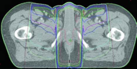 Pelvic contouring figure from the book with target volumes and organs at risk