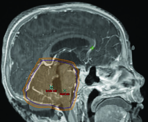 Corte sagital de RM mostrando CTV y PTV de la fosa posterior completa en meduloblastoma de alto riesgo con diseminación en los folios cerebelosos