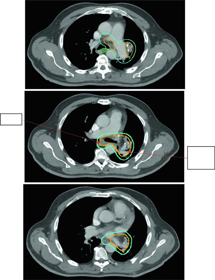 Radioterapia pós-operatória em NSCLC incluindo nível 7 e coto brônquico ipsilateral