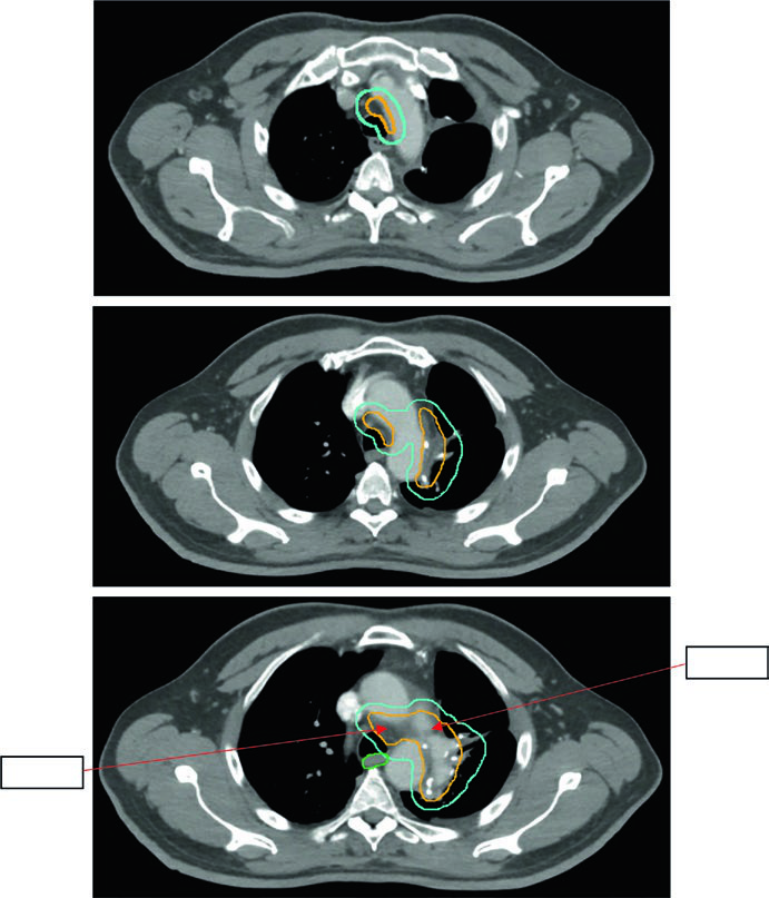 Radioterapia pós-operatória em NSCLC com cobertura dos níveis 5 e 4L