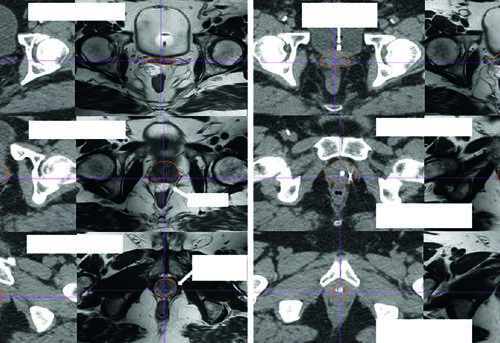 Adenocarcinoma de Próstata: CTV e IMRT