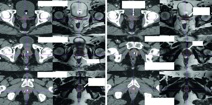 Adenocarcinoma de Próstata: CTV e IMRT