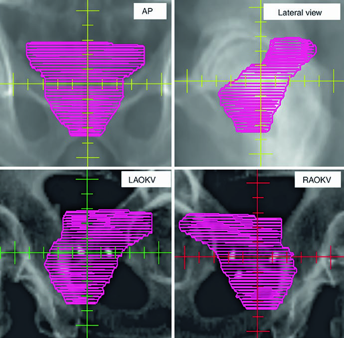 Three-dimensional prostate CTV projection in AP, lateral, and oblique views for contour quality assessment