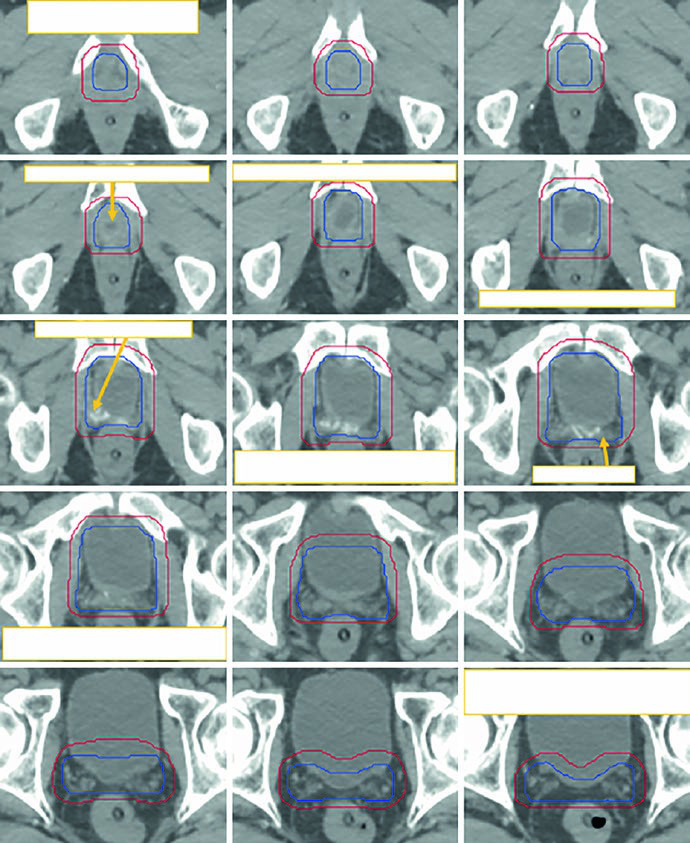 Post-prostatectomy target delineation with initial CTV in blue and modified PTV in red from the vesicourethral anastomosis cranially