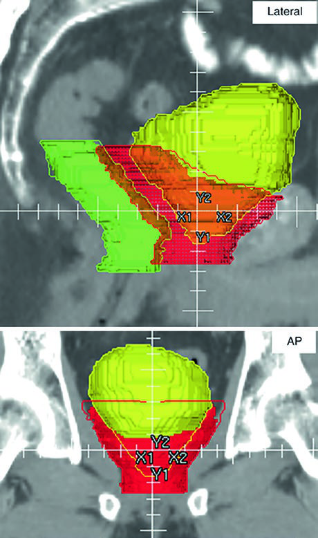 Orthogonal postoperative PTV projection showing overlap with rectum and bladder during quality assessment