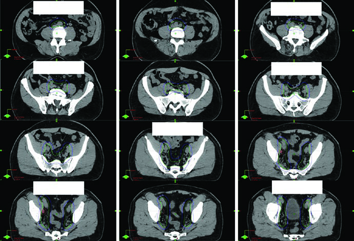 Pelvic lymph node target delineation from the aortic bifurcation through common internal and external iliac regions with gross nodal boost