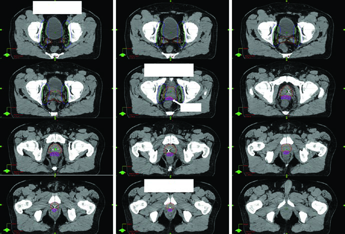 Pelvic nodal and prostate target delineation with rectal spacer seminal vesicle coverage and caudal stop above the genitourinary diaphragm