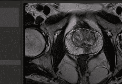 Rastreio do Câncer de Próstata com RM Ganha Força