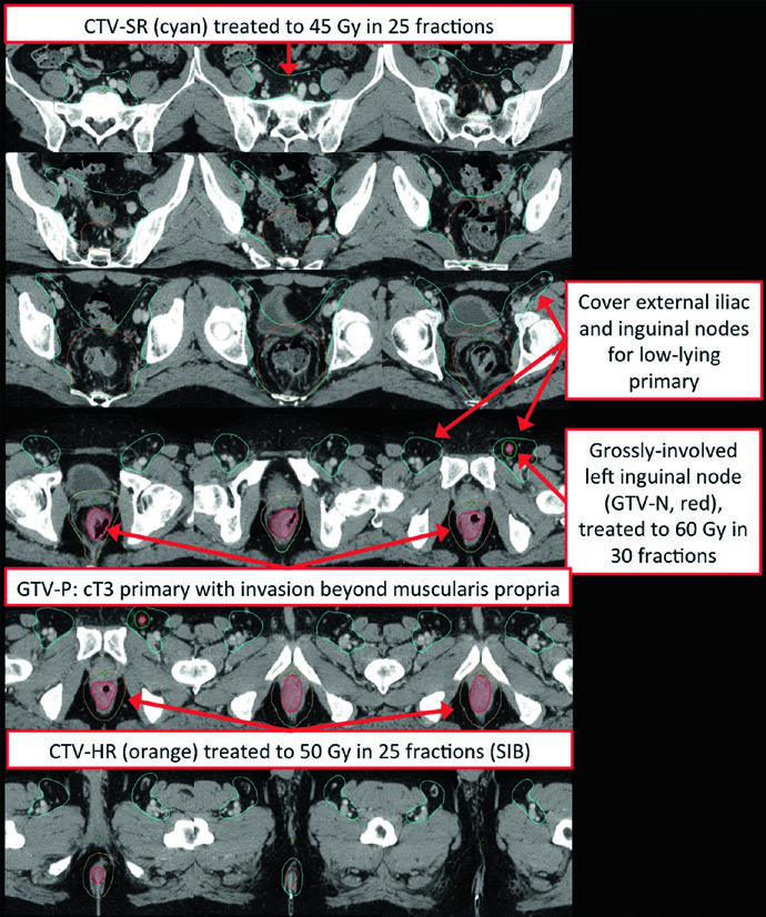 Plano IMRT para tumor retal baixo cobrindo cadeias iliacas externas e inguinais