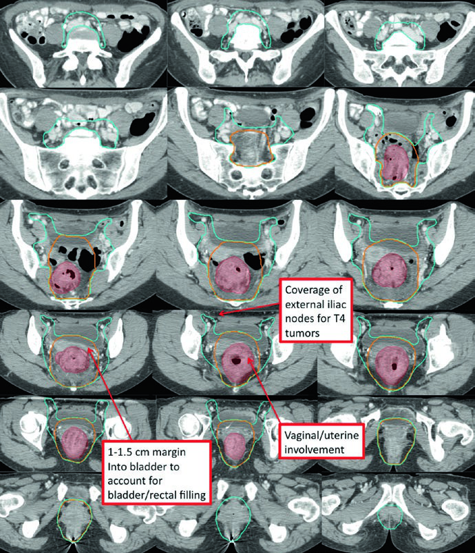 Plano de cancer retal T4 com invasao do colo do utero e cobertura de iliacas externas