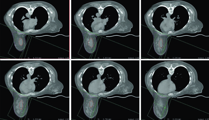 Series of breast regional nodal irradiation planning slices from the book