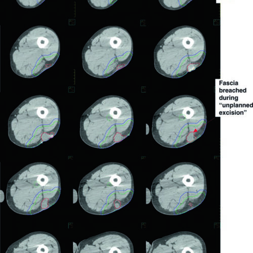 Sarcoma de Partes Moles: Delineamento e Planejamento