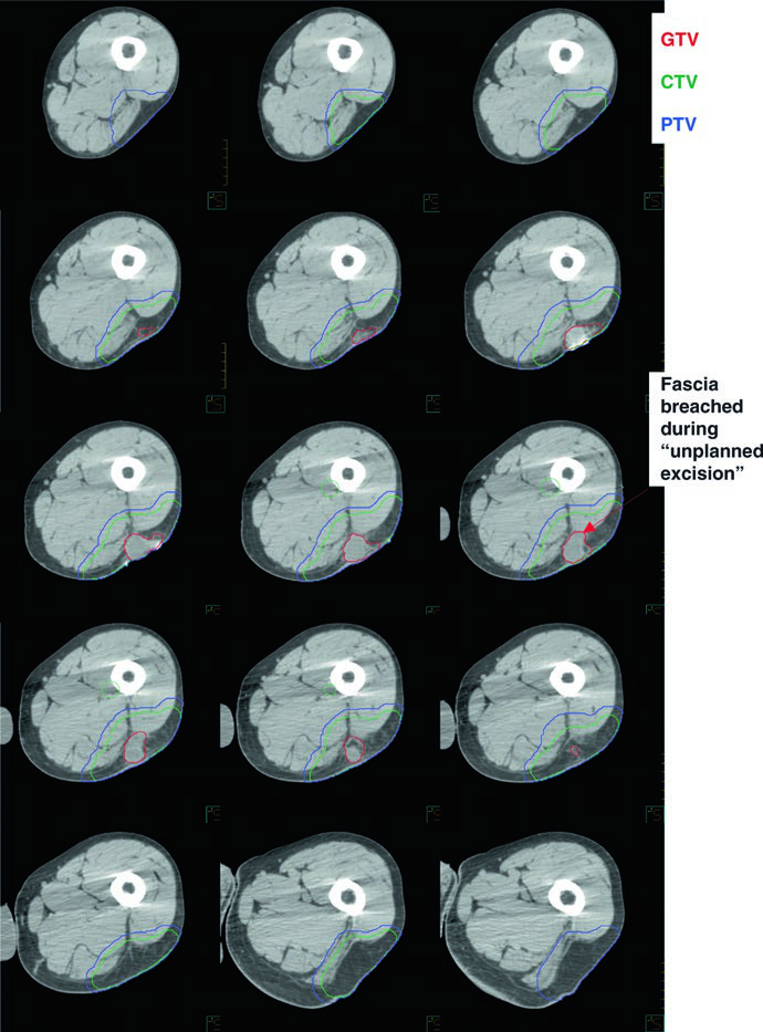 Sarcoma de Partes Blandas: Delineación y Planificación
