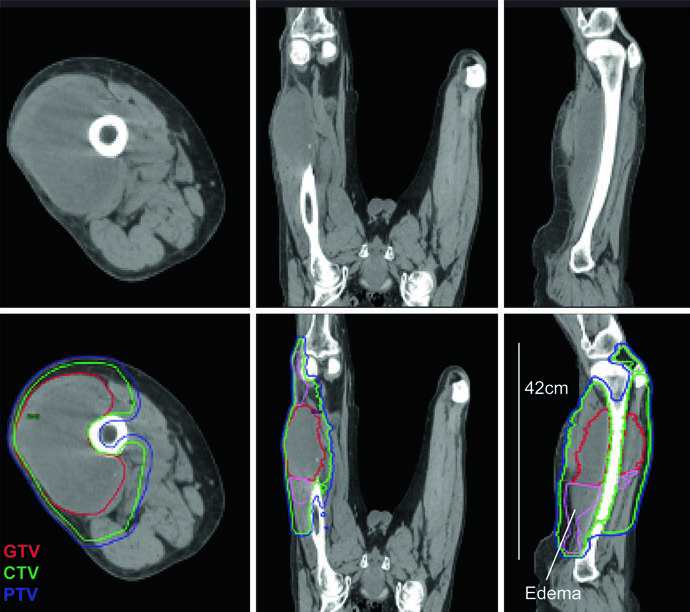 Cortes axiales, coronales y sagitales de TC mostrando mixofibrosarcoma de muslo con edema extenso, PTV de 42 cm y técnica IMRT de doble isocentro cooptimizada