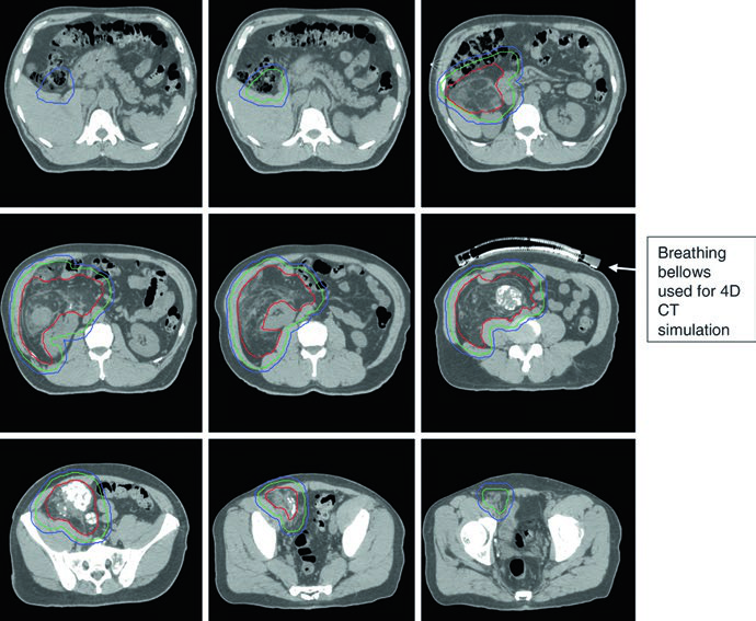 Cortes axiales de TC de simulación de sarcoma retroperitoneal con GTV, CTV y PTV, mostrando fuelle respiratorio para 4DCT y calcificaciones tumorales para guía de imagen diaria