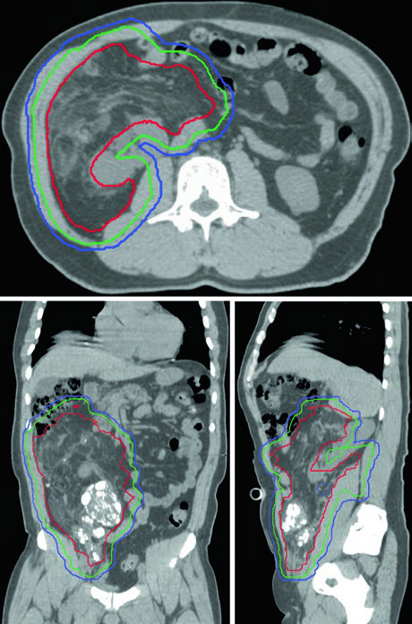Vista axial, coronal y sagital de sarcoma retroperitoneal mostrando desplazamiento intestinal por el tumor, ventaja principal de la radioterapia preoperatoria