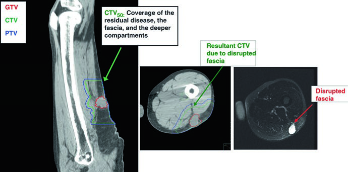 Vistas sagital y axial mostrando GTV, CTV50 y PTV con cobertura de fascia rota y compartimentos profundos tras excisión no planificada