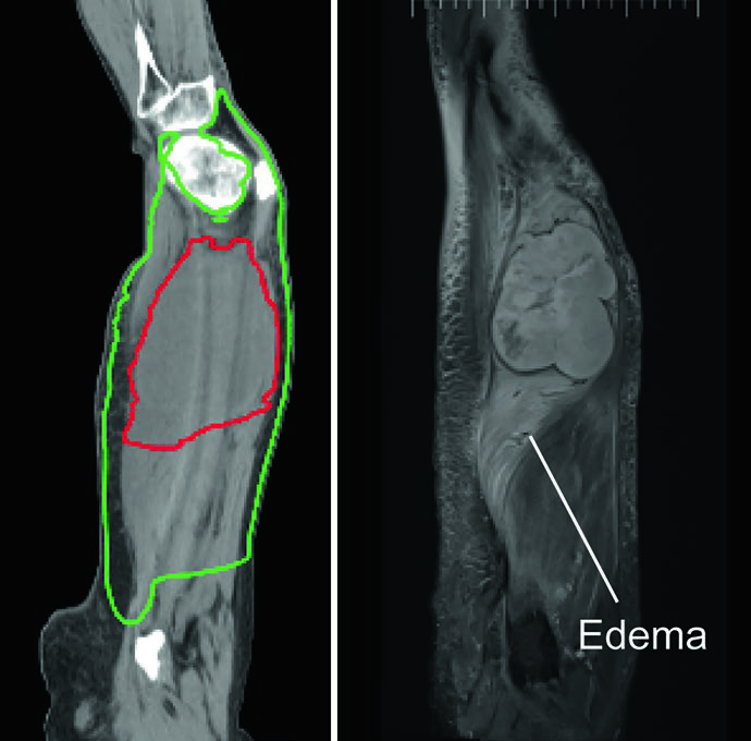Vista sagital de TC y RM T2 mostrando edema peritumoral extenso longitudinal con CTV50 definido por la extensión del edema y márgenes habituales de PTV