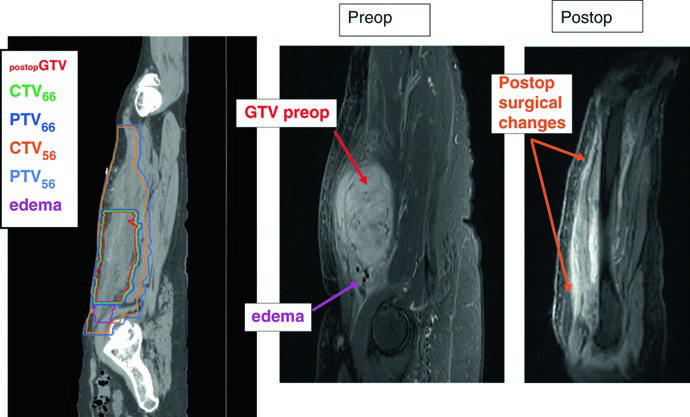 Vista sagital de TC de simulación con volúmenes postoperatorios y comparación de RM pre y postoperatoria mostrando GTV original, edema y cambios quirúrgicos
