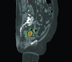 Boost de SBRT em corte sagital para câncer cervical mostrando marcadores fiduciais e distribuição de dose