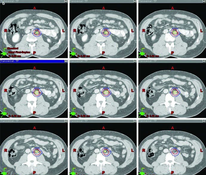 Boost volume example for stage IIA seminoma on axial CT, showing GTV in yellow, CTV in red, and PTV in blue across superior-to-inferior slices.
