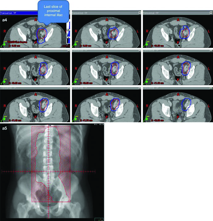 Porção inferior do campo dogleg no seminoma testicular estágio II, com CTV em vermelho e PTV em azul, mostrando cobertura nodal pélvica e projeção do campo inferior.