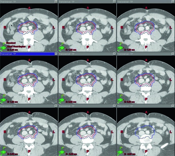 Continuation of the stage I seminoma para-aortic target volume montage on axial CT, illustrating the superior-to-inferior extent of the vascular-based CTV and PTV.