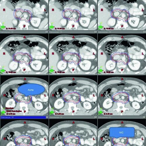 Seminoma Testicular: Campos e Delineamento