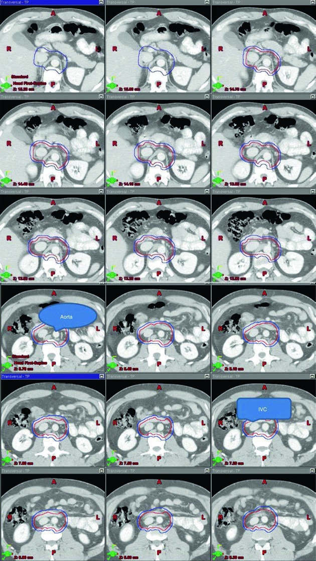 Seminoma Testicular: Campos e Delineamento