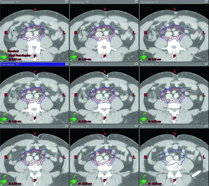 Continuação dos cortes axiais do estágio I no seminoma testicular, destacando cobertura para-aórtica com CTV em vermelho e PTV em azul ao redor da aorta e da veia cava inferior.