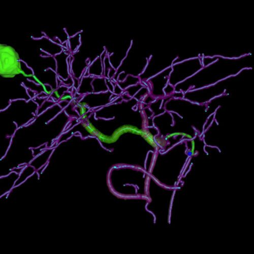 Siemens Lança Angiografia com IA para Embolização