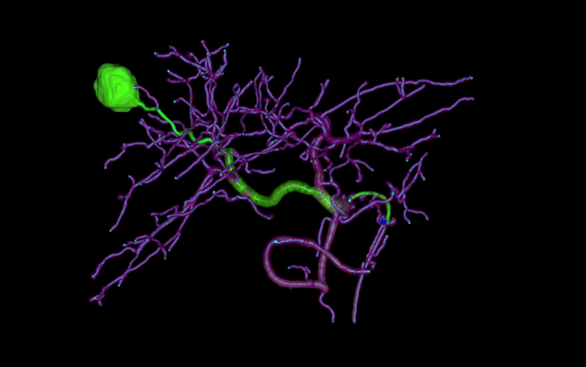 Siemens Healthineers sistemas de angiografía Artis con IA