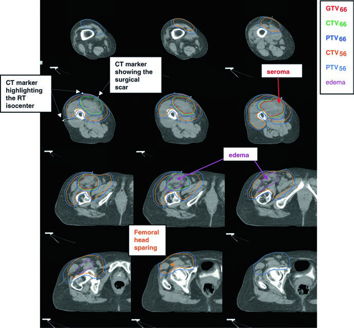 Representative postoperative CT simulation slices of left thigh pleomorphic rhabdomyosarcoma with superior edema included in CTV56 and target limited by femoral head and bone