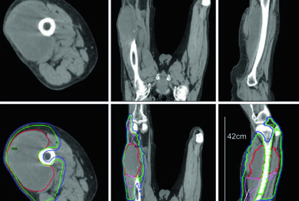 Axial, coronal, and sagittal CT simulation views of preoperative left thigh myxofibrosarcoma with extensive edema in CTV50 and a 42 cm PTV treated with dual-isocenter IMRT