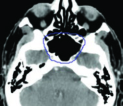 Delineamento de Volume Alvo: Guia Completo