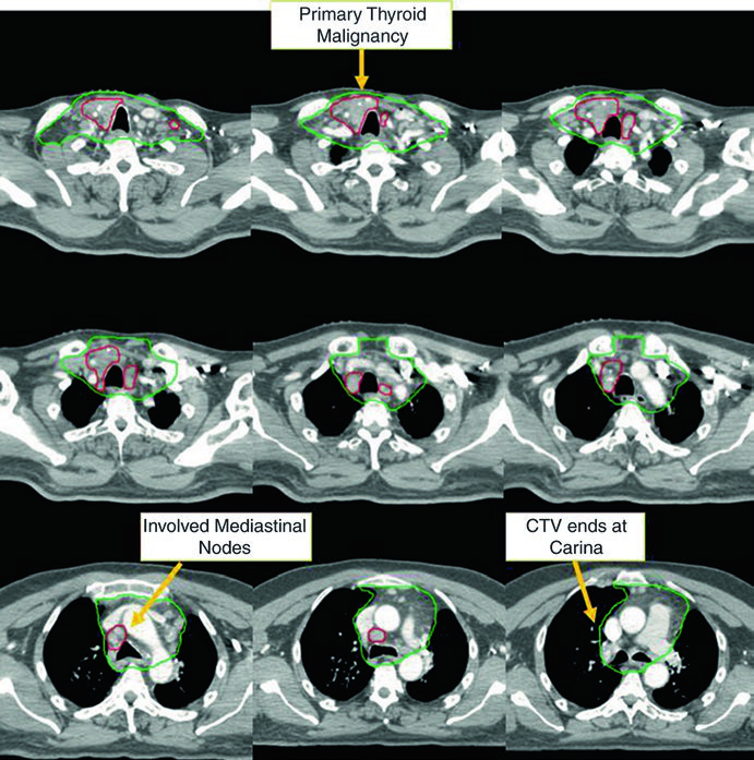 Cortes axiais de recidiva papilífera com doença cervical e mediastinal, com alvo de alta dose em vermelho e CTV em verde.